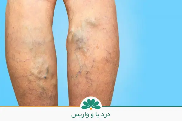  علت درد پا از زانو به پایین و تصویر پای مبتلا به نقرس | شفاکاران