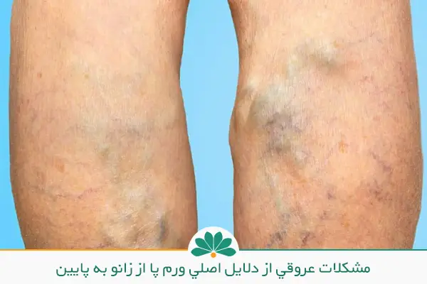 علت ورم پای چپ از زانو به پایین و تصویر پایی با مشکلات عروقی | شفاکاران