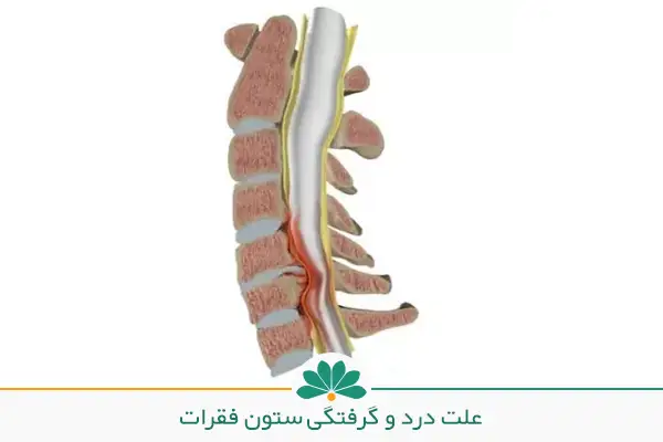تصویری از ستون فقرات و  علت درد ستون فقرات بالای کمر | شفاکاران