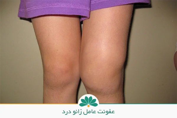 زانو درد بعد از دویدن و زانوی متورم | شفاکاران