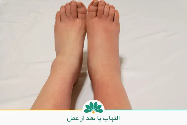  تصویر پای ملتهب و درد پا بعد از عمل دیسک کمر | شفاکاران