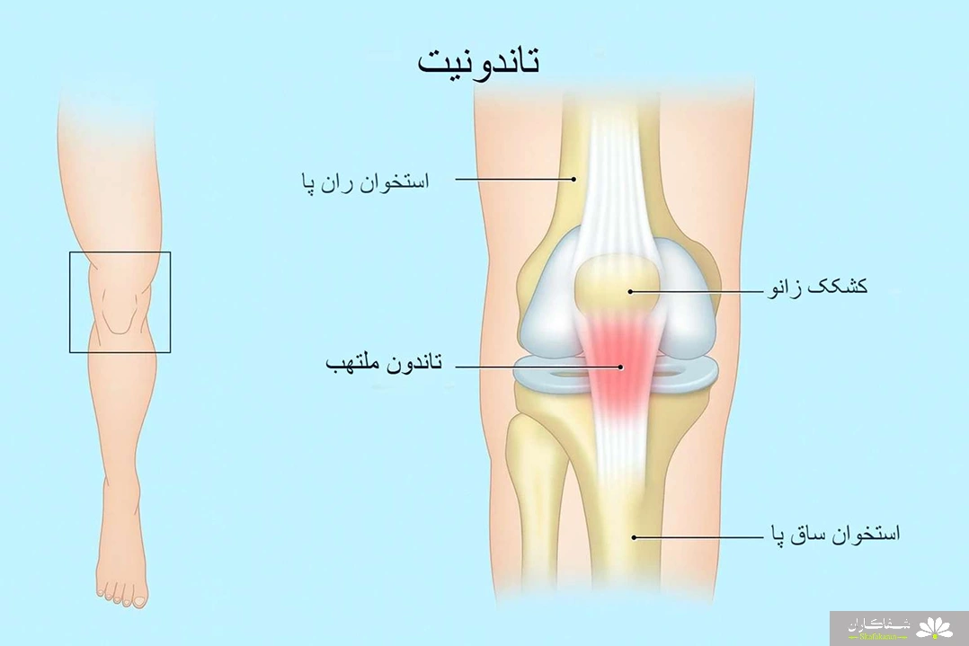 تاندونیت زانو