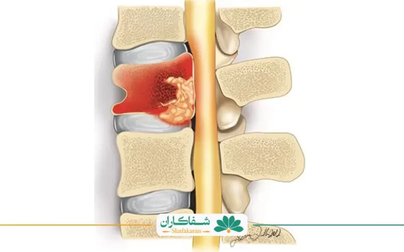عفونت ستون مهره‌ها | شفاکاران