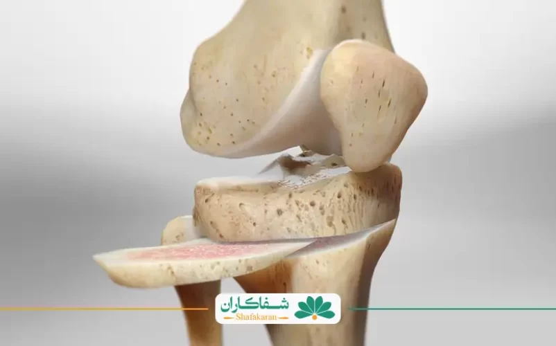 عمل استئوتومی زانو | شفاکاران