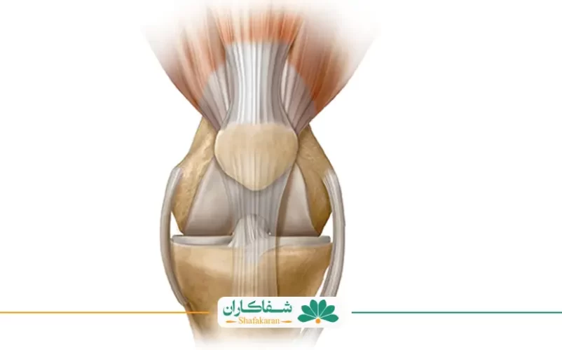 پارگی رباط صلیبی | شفاکاران
