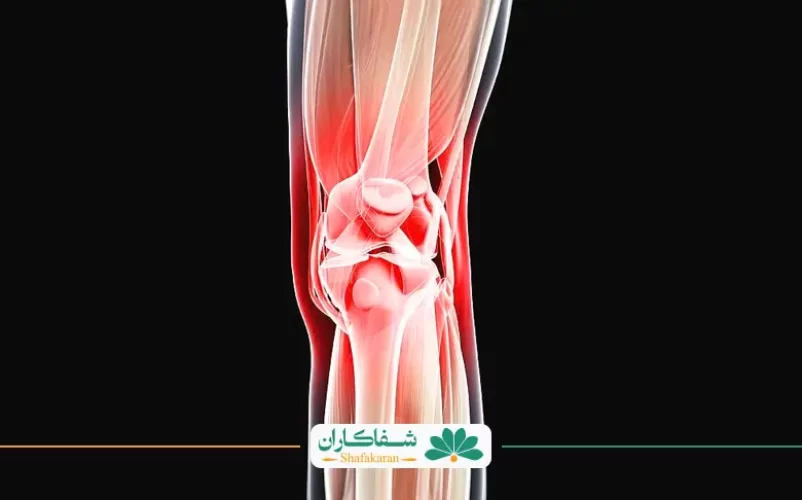 کشیدگی پشت زانو | شفاکاران