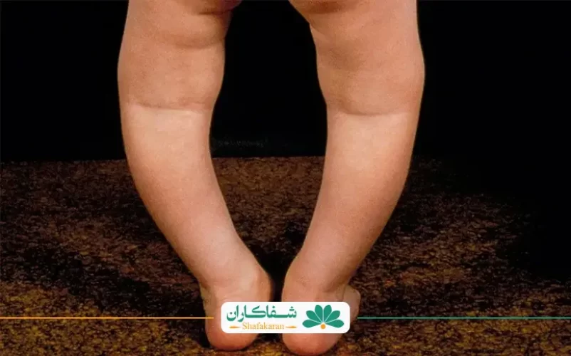 راشیتیسم | شفاکاران