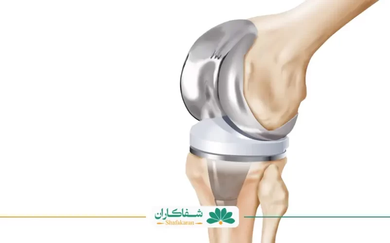 پروتز مفصل زانو | شفاکاران