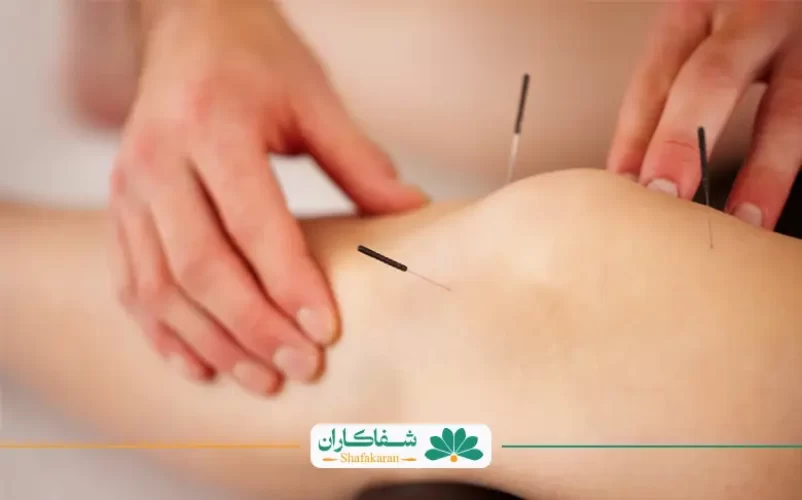 طب سوزنی زانو | شفاکاران