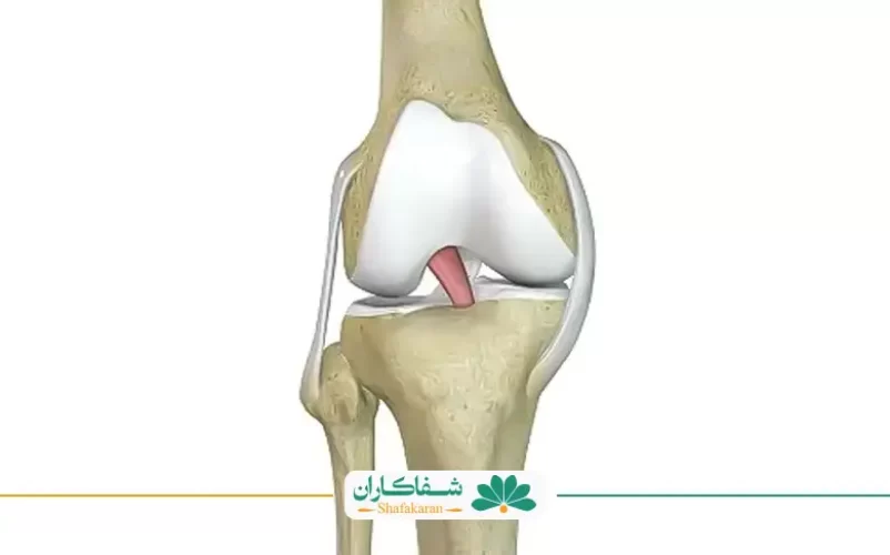 جوش خوردن رباط صلیبی | شفاکاران