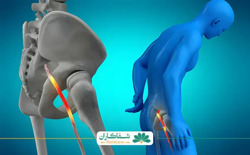 سیاتیک پای راست