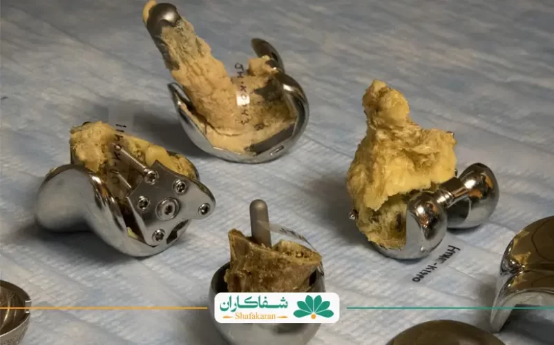 عفونت پروتز زانو | شفاکاران