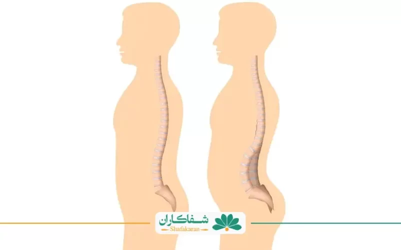 ورزش برای گودی گمر | شفاکاران