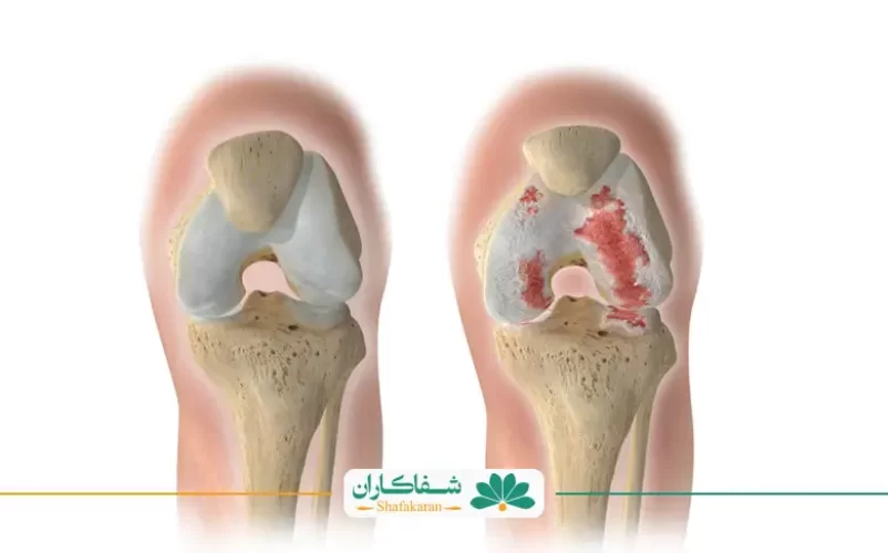 زانوبند مخصوص ساییدگی زانو | شفاکاران
