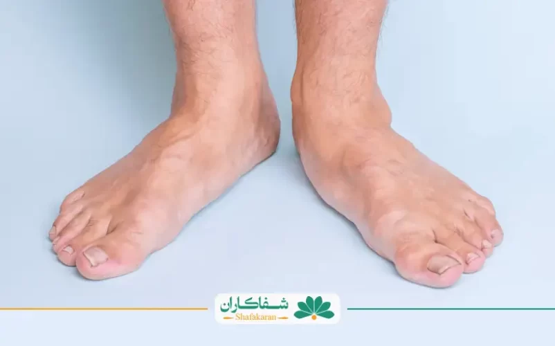 ورزش برای کف پای صاف | شفاکاران