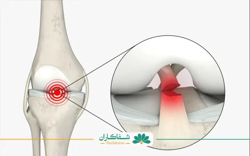 علائم پارگی رباط زانو | شفاکاران