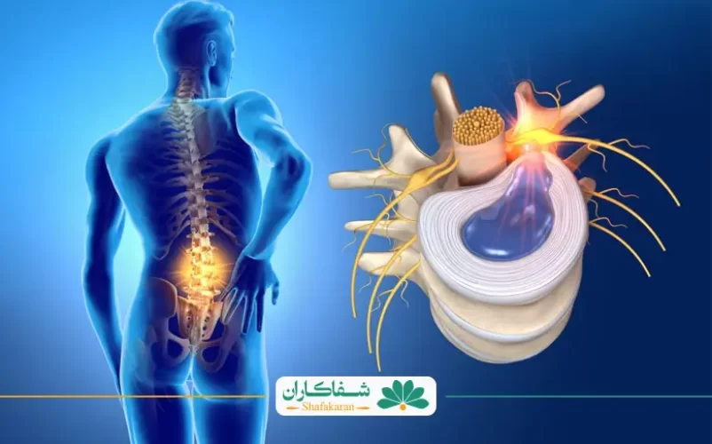 علائم دیسک کمر خفیف و شدید | شفاکاران