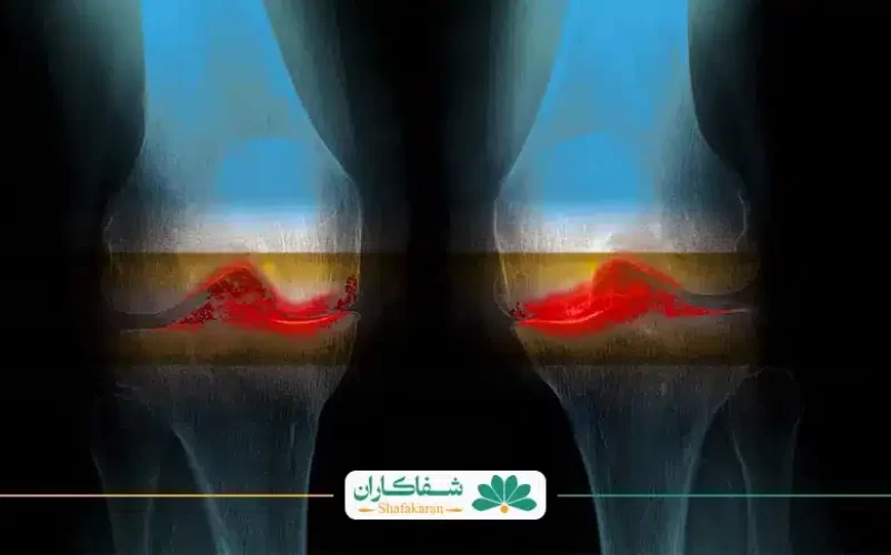 درمان ساییدگی زانو | شفاکاران