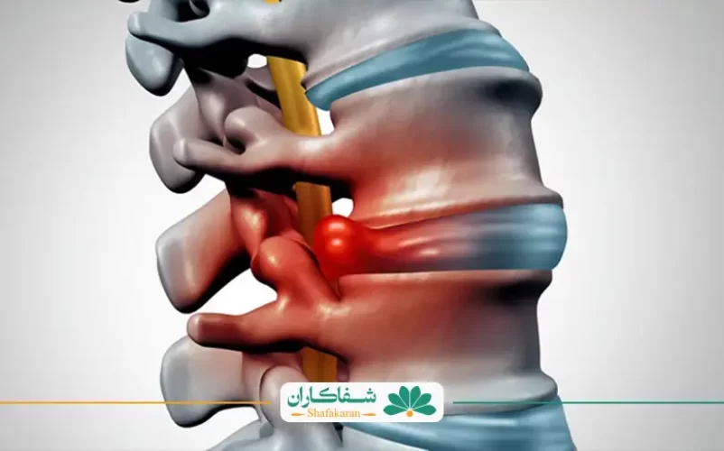 آمپول ضد التهاب دیسک کمر | شفاکاران