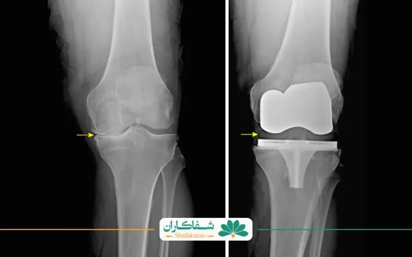 راه رفتن بعد از تعویض مفصل زانو و عکس زانو | شفاکاران