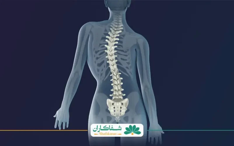 ورزش برای اسکولیوز مناسب است | شفاکاران