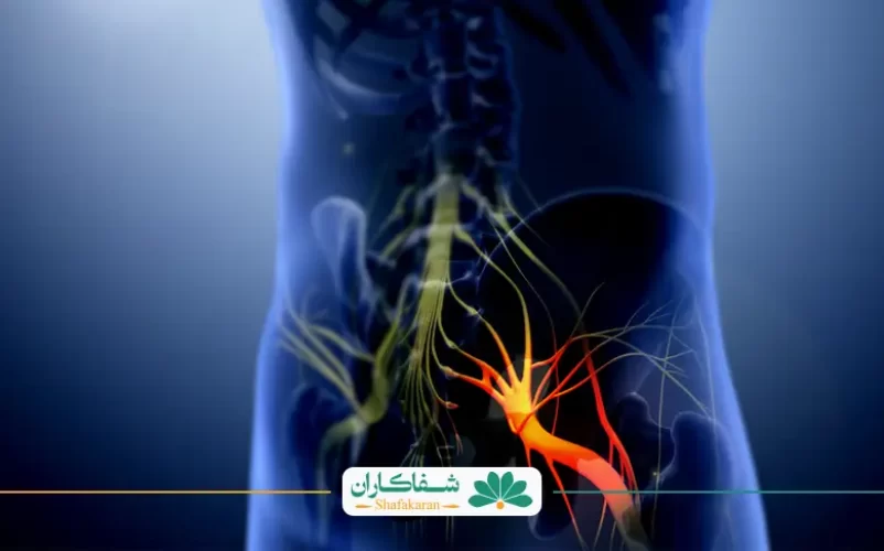 پیاده‌روی برای سیاتیک و دیسک کمر | شفاکاران