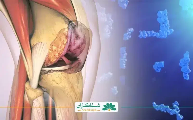 غذاهای مضر برای زانو درد | شفاکاران