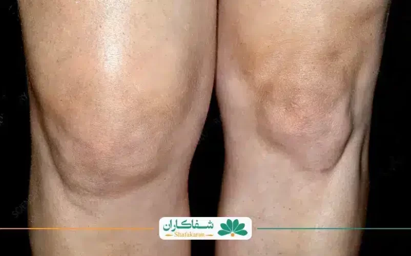 عکس برداری ورم زانو | شفاکاران