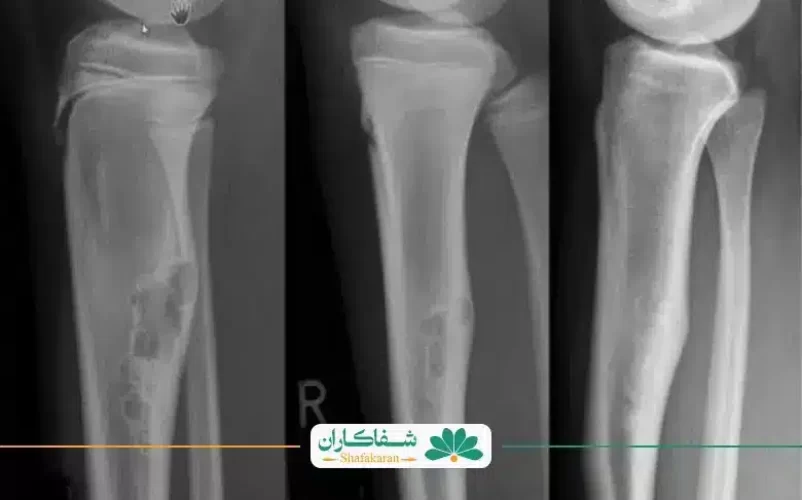 تصویر رادیولوژی از سرطان استخوان | شفاکاران