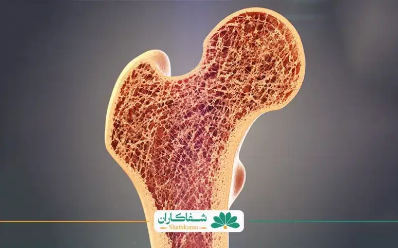 کمبود کلسیم و تصویر استخوان | شفاکاران