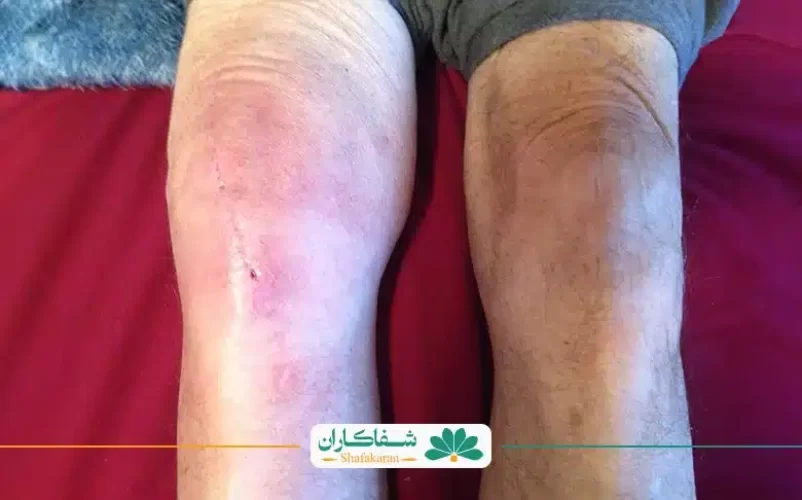 عفونت مفصل زانو | شفاکاران