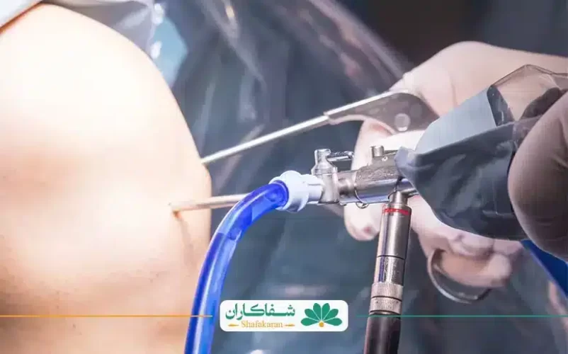 آرتروسکوپی زانو | شفاکاران
