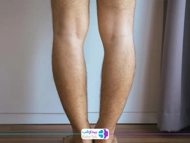 حرکت اصلاحی پای پرانتزی|شفاکاران