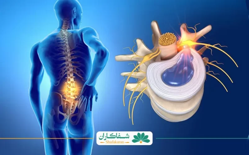 دلیل دیسک کمر یکی از بیماری های رایج در میان افراد مختلف است|شفاکاران