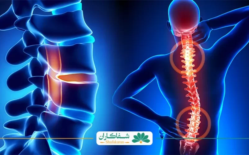 دیسک کمر | شفاکاران