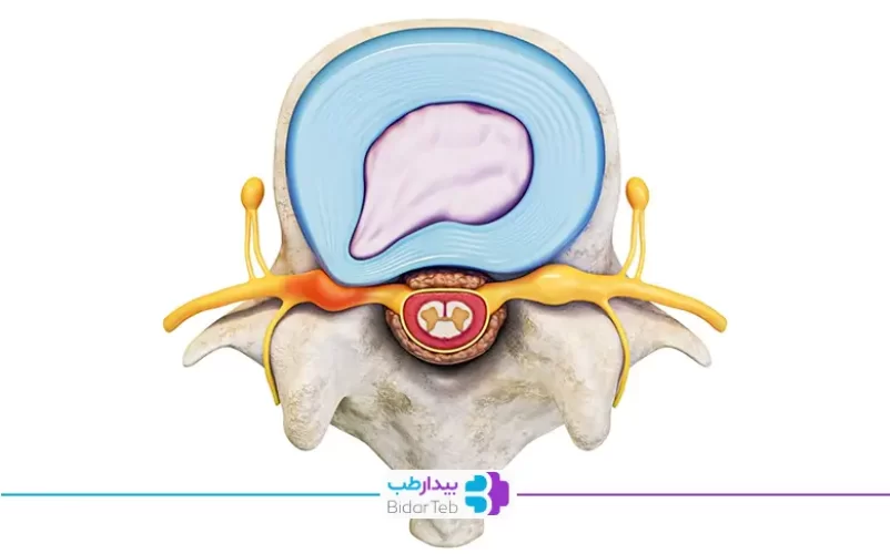 قرص ضد التهاب دیسک کمر برای تسکین درد و التهابات|شفاکاران