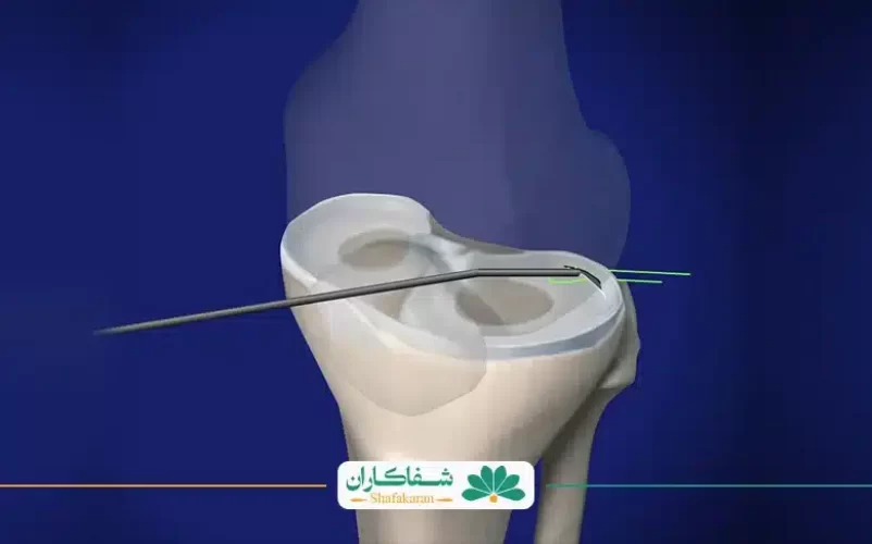 مراقبت بعد از عمل مینیسک زانو | شفاکاران
